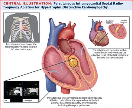 肥厚型心肌病最新治疗进展概览
